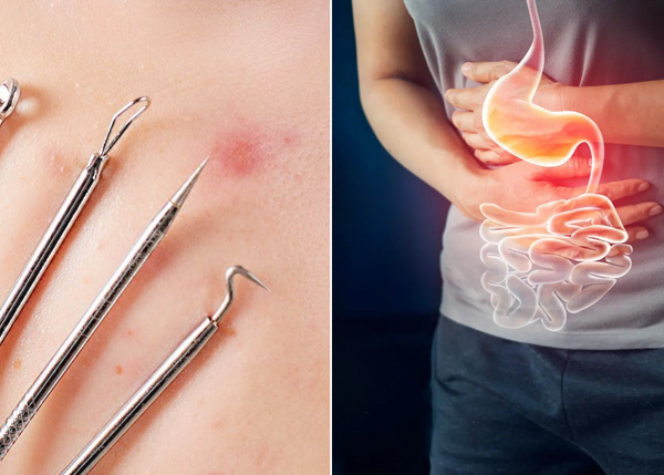 Is Your Gut Trying to Tell You Something? 10 Signs of Poor Gut Health